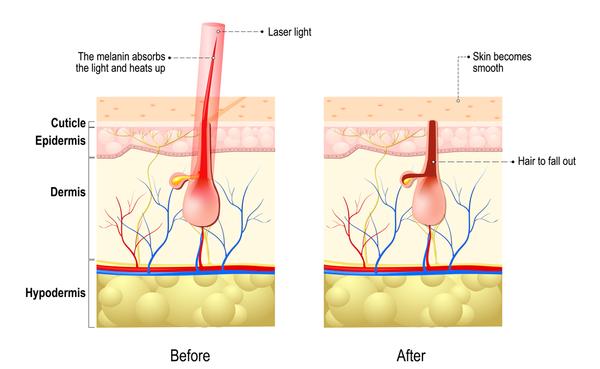 Wetty Pro Hair Removal Laser