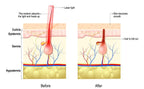 Wetty Pro Hair Removal Laser